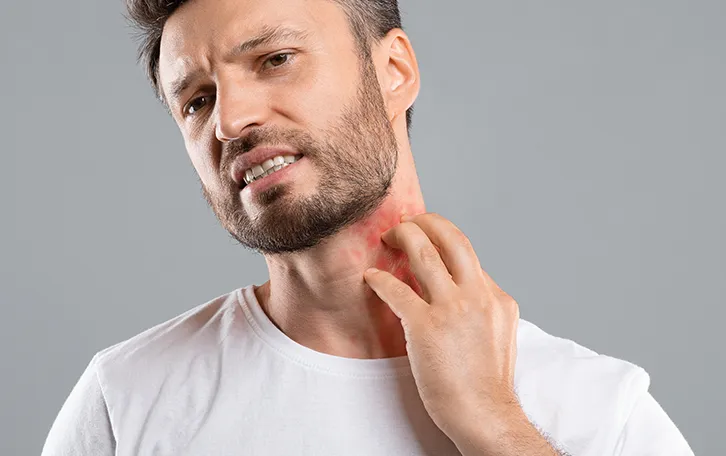 Erythrasma Oberflächige Hautinfektion Eine männliche Person mit Ekzemen im Halsbereich und einer Hand davor, als würde er sich kratzen