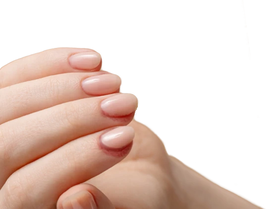 Finger Fingernägel mit rötlichen Stellen am Nagelbett