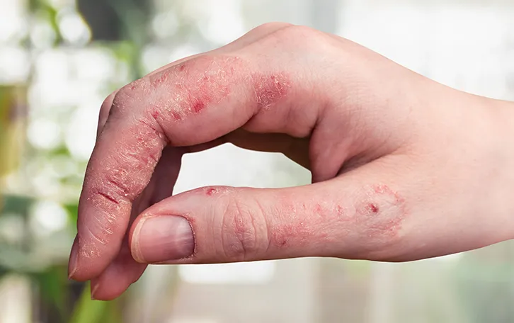 Aufgerissene Haut an der rechten Hand im Daumen & Zeigefingerbereich