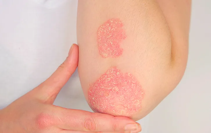 Hautflechte Infektion verschiedene Pilzarten Ekzeme am Ellebogenaussenbereich