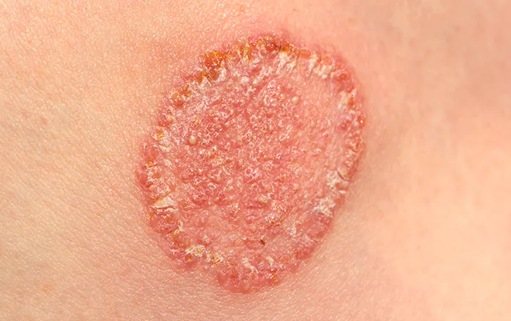 Ekzem/Hautpilz Nahaufnahme