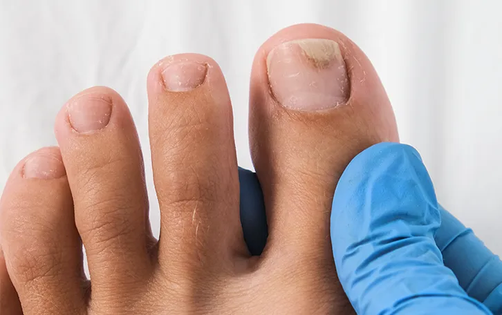 Nahaufnahme eines dicken Zehs, der durch eine Hand in Latex Handschuhen gehalten wird