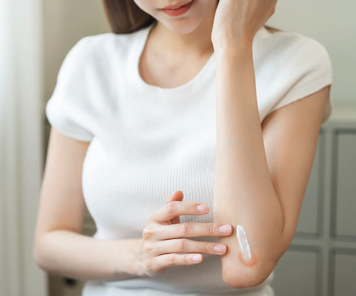 Ein weiblich Person mit einer größeren roten Stelle im Außenbereich der Armbeuge mit einem Streifen Creme drüber und die andere Hand in der Nähe