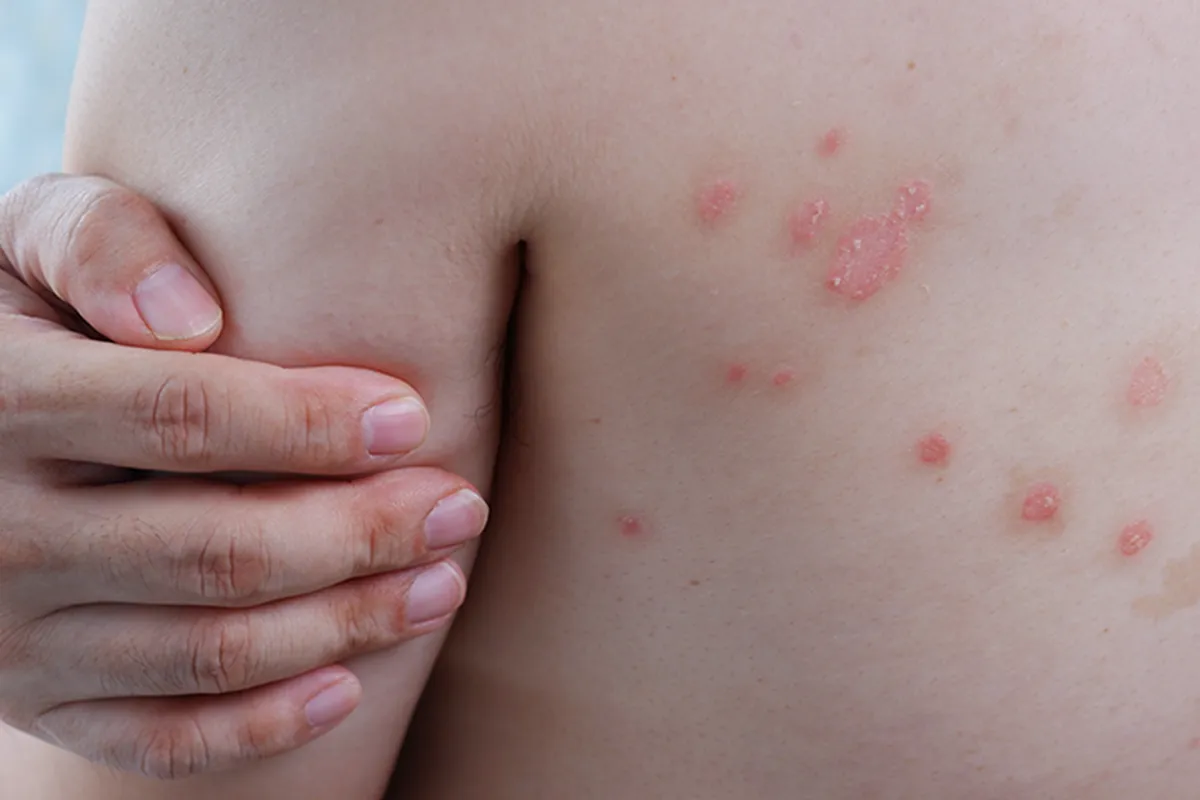 Rote Stellen bis Bläßchen im Schulterblattbereich einer Person