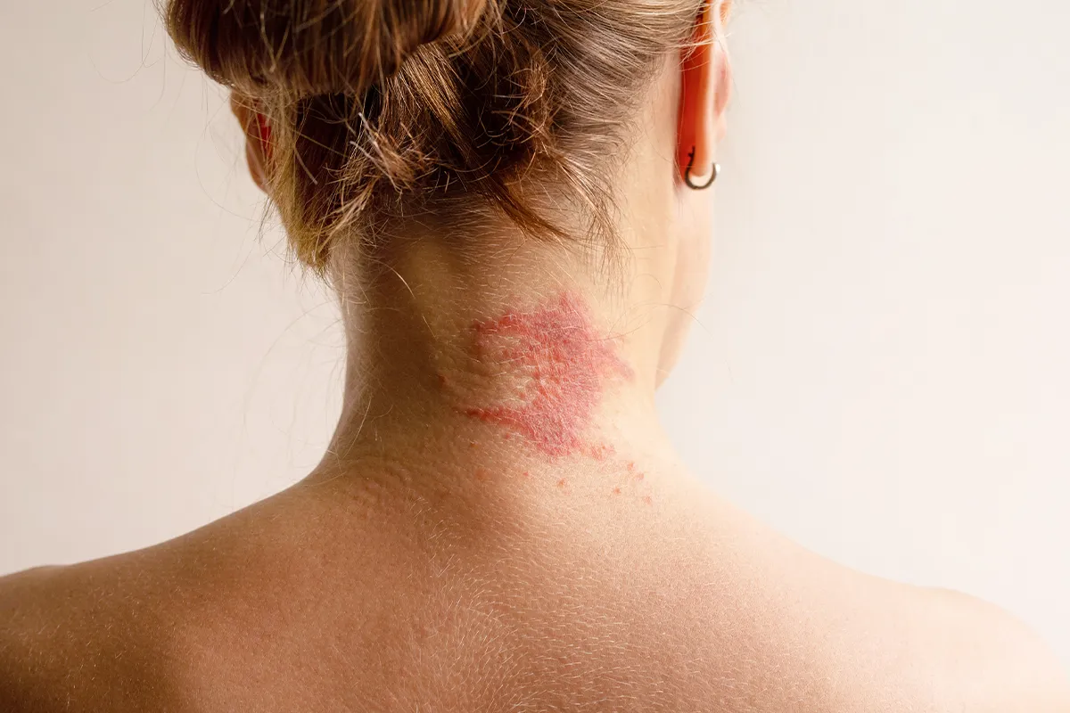 Größes rötliches bis offenes Ekzem im rechten Nackenbereich einer weiblichen Person