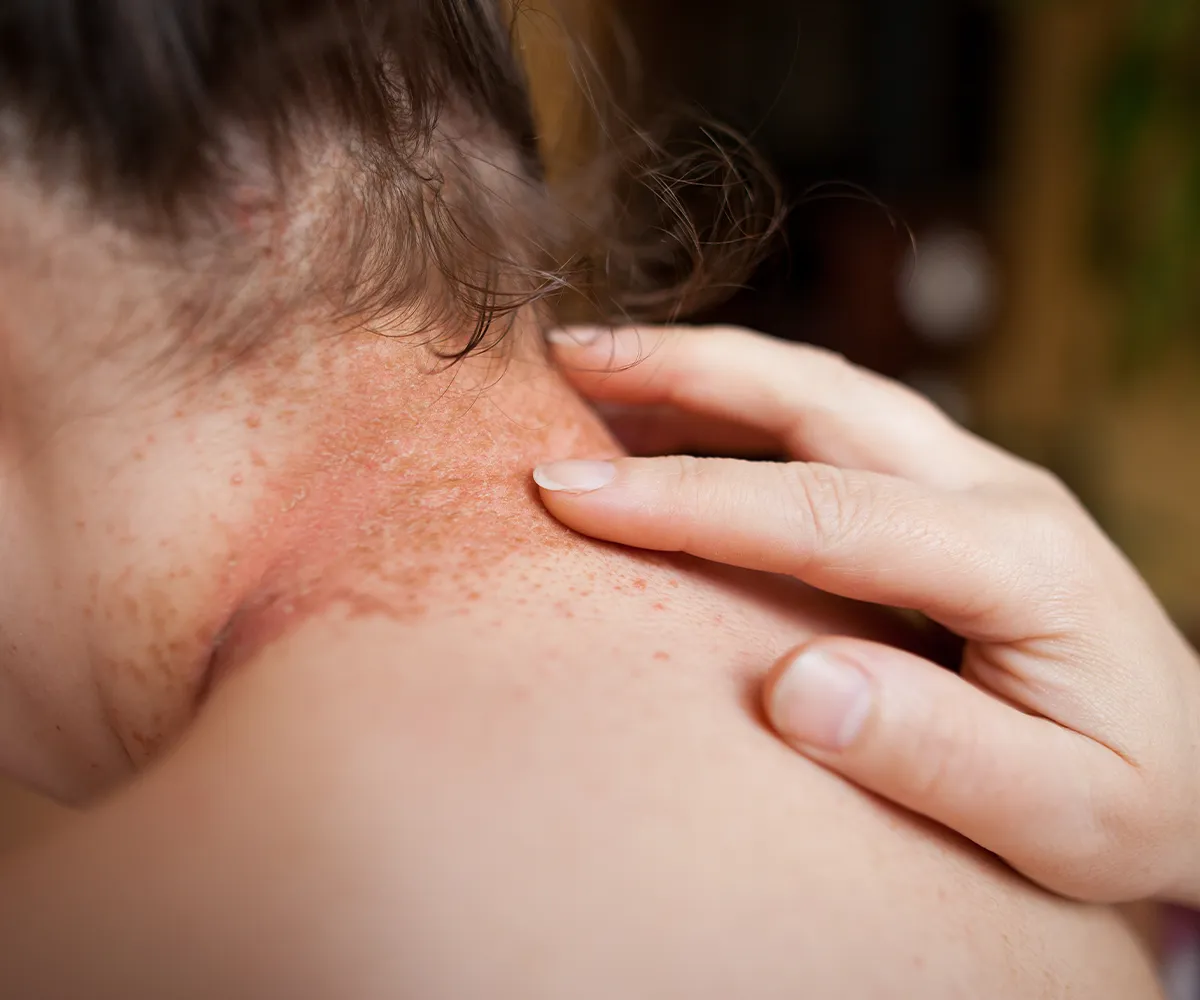 Ein Hand liegt auf einem Nackenbereich auf. Dieser ist gerötet und mit verkrustet Bläßchen belegt