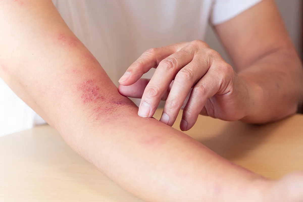 Eine extrem geörtete bis offene Ellebogenbeuge auf der die Hand des anderen Arm anliegt