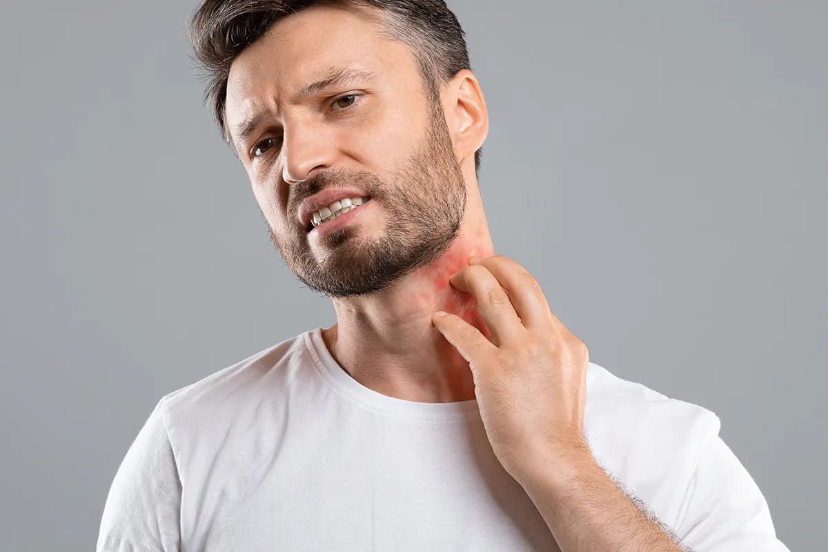 Eine männliche Person mit Ekzemen im Halsbereich und einer Hand davor, als würde er sich kratzen