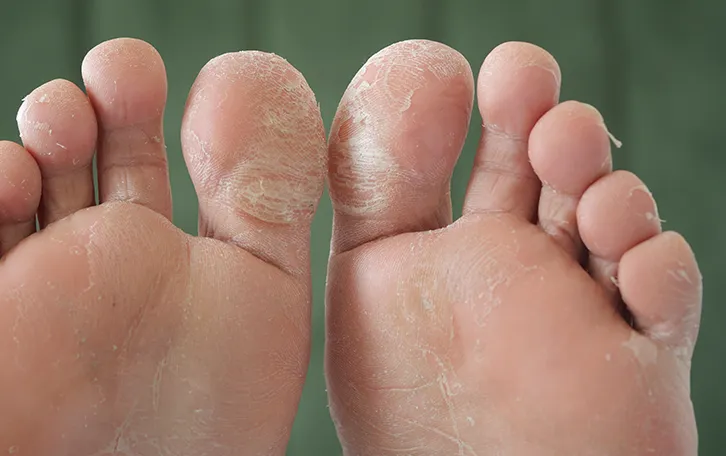 Fussunterseiten mit Schuppung an den Zehen und Ballenbereich
