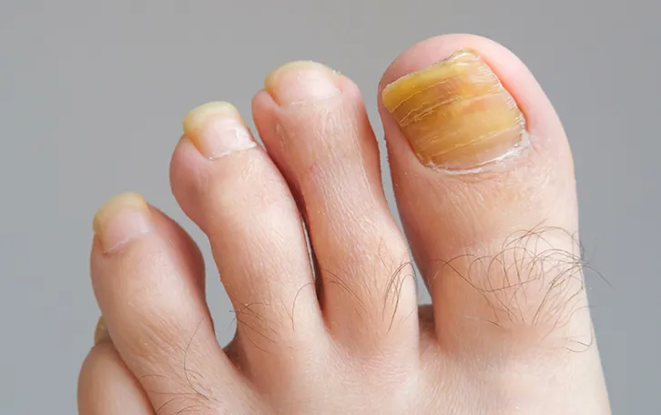 Nahaufnahme von gelblich gefärbten Zehennägeln am linken Fuss
