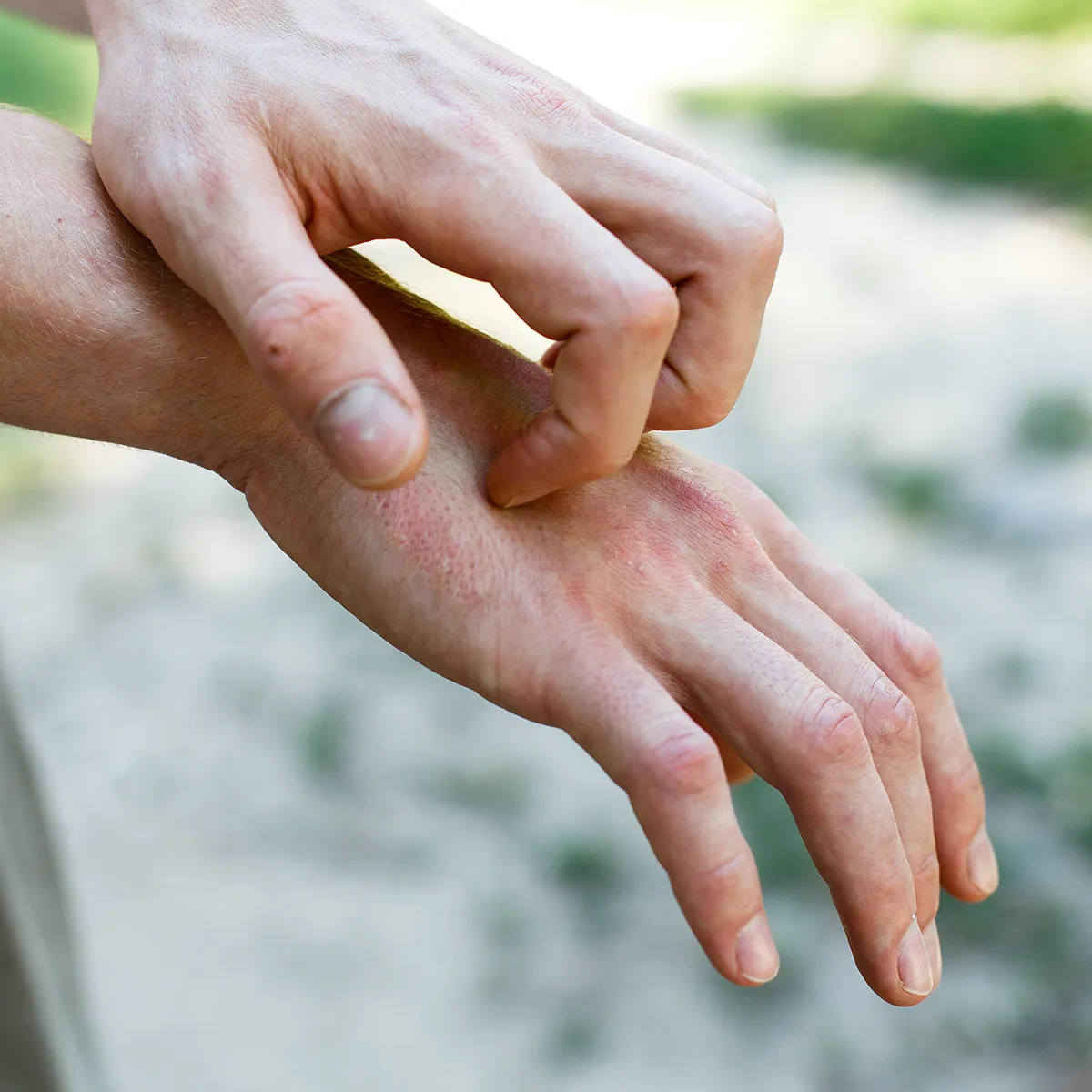 Eine Hand liegt zum kratzen auf dem Handrücken einer Anderen an