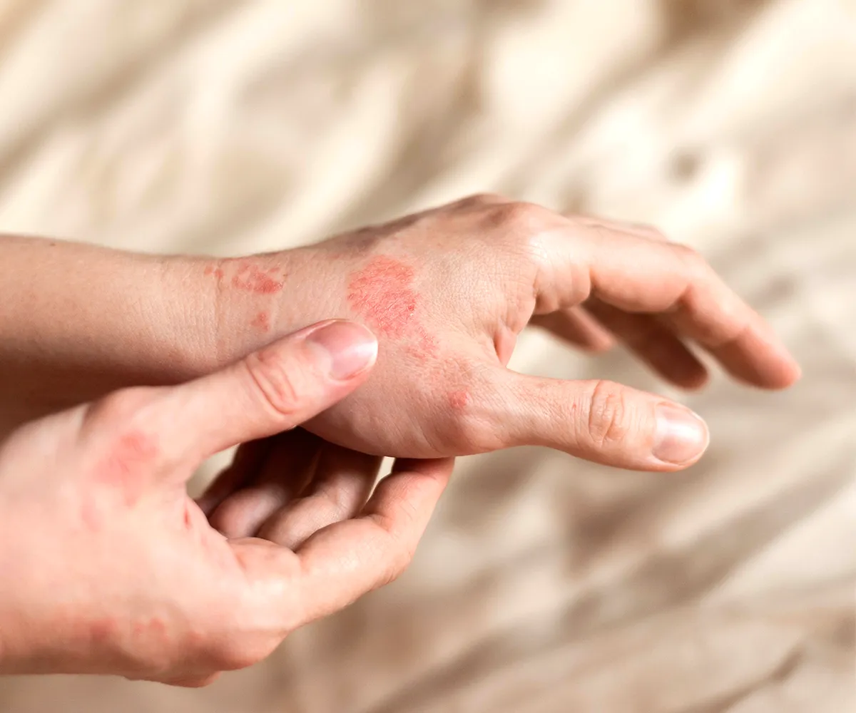 Pilzinfektion Hautflechte durch Kleiepilz Eine Hand mit rissigen roten Stellen auf dem Handrücken wird von einer Hand gehalten