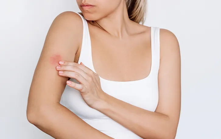 Pilzinfektion Hautflechte Kleiepilze Symptom Juckreiz Eine weibliche Person rötlicher Haut am äußeren oberen Arm