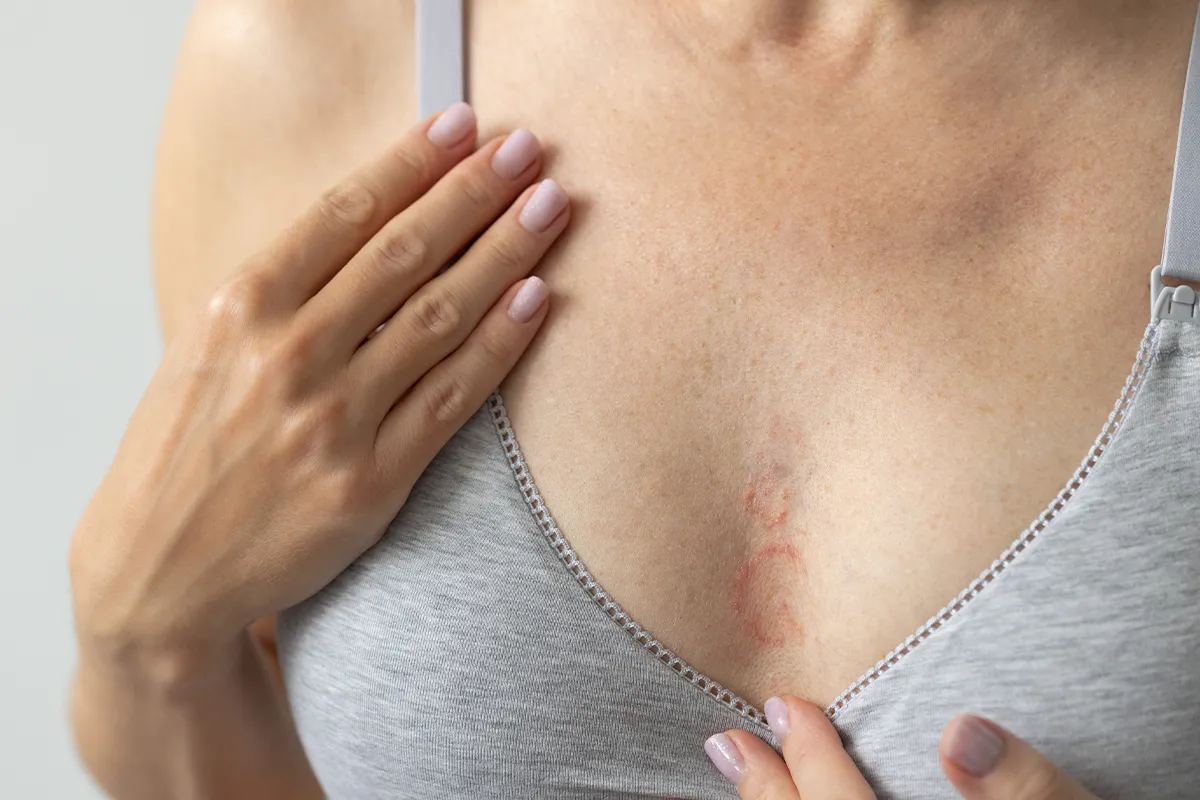 Pilzinfektion Hautflechte Kleiepilze Symptome erkennen Rötliche Stellen im Dekoltee einer weiblichen Person