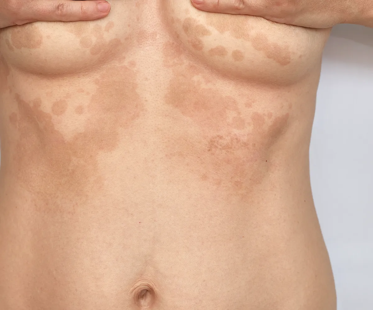 Pilzinfektion Hautflechte Kleiepilze Ursachen Pikmentstörungen im Brust und oberer Bauchbereich einer weiblichen Person