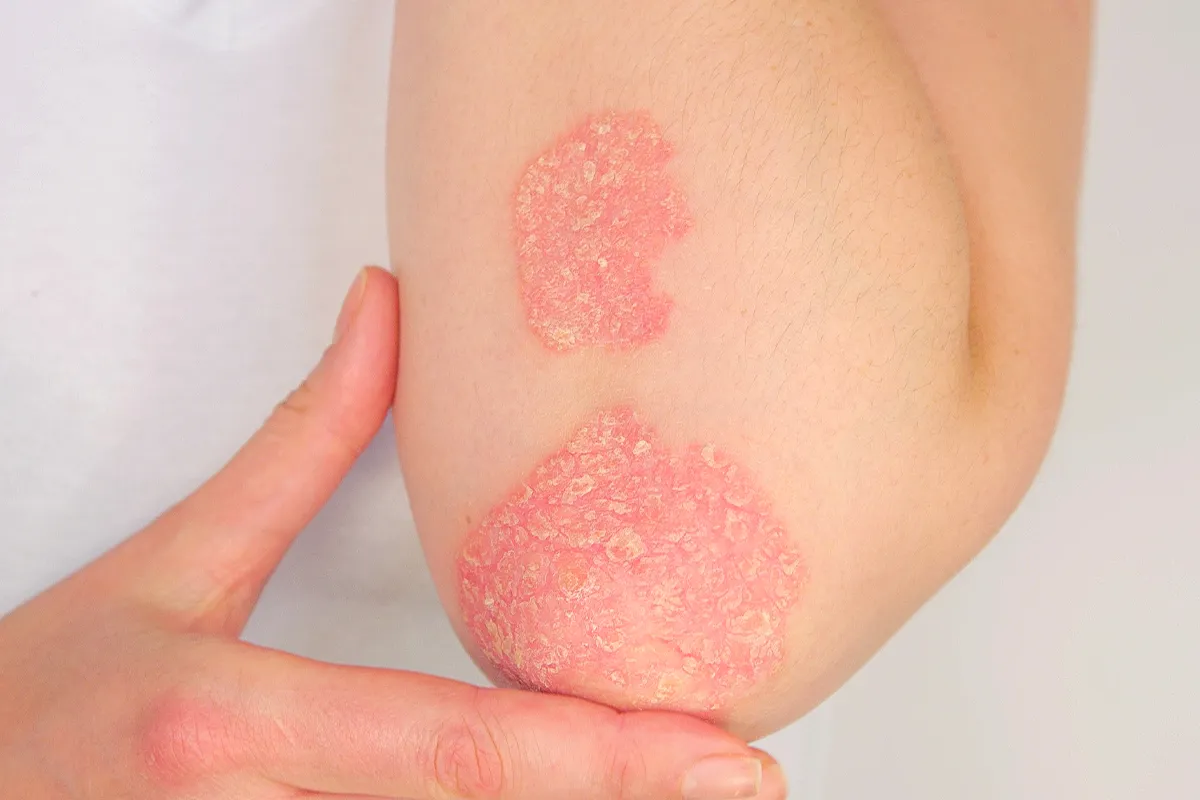 Pilzinfektion Hautflechte Symptome Behandlung Ekzeme am Ellebogenaussenbereich