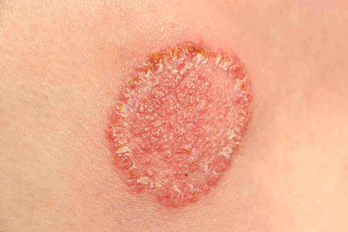 Pilzinfektion Hautpilz effektiv behandeln Ekzem/Hautpilz Nahaufnahme