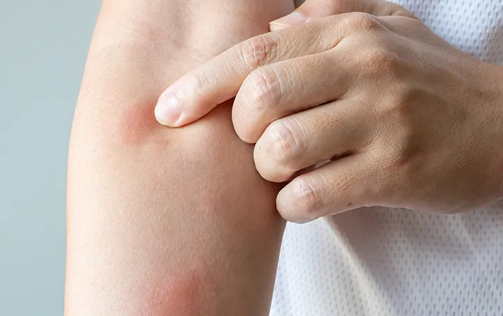 Pilzinfektion Hautpilz Symptom Rötung Ein Zeigefinger zeigt auf eine gerötete Stelle im Beugebereichs eines Arms