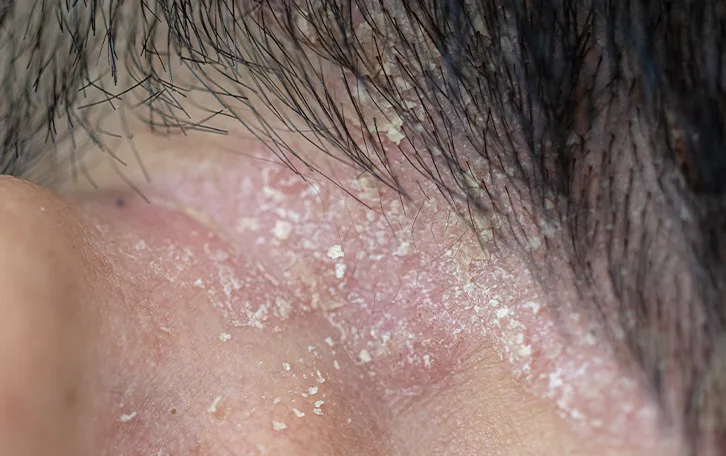 Pilzinfektion Hautpilz Symptom Schuppungen Nahaufnahme von schuppiger roter Haut im Ohrenbereich