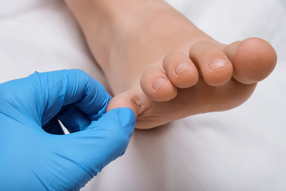 Ein Hand in Latexhandschuhen zieht den kleinen Zeh eines Fuss bei seite. An der Innenseite befindet sich eine bräunliche offene Stelle