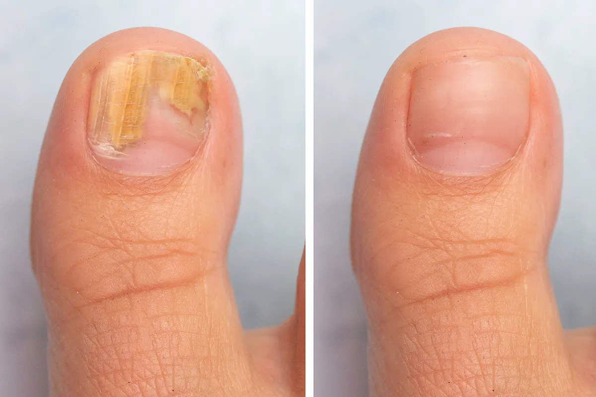 Pilzinfektion Nagelpilz Behandlungsdauer Vergleichsbild eines dicken Zehnagel mit Pilzbefall und ohne