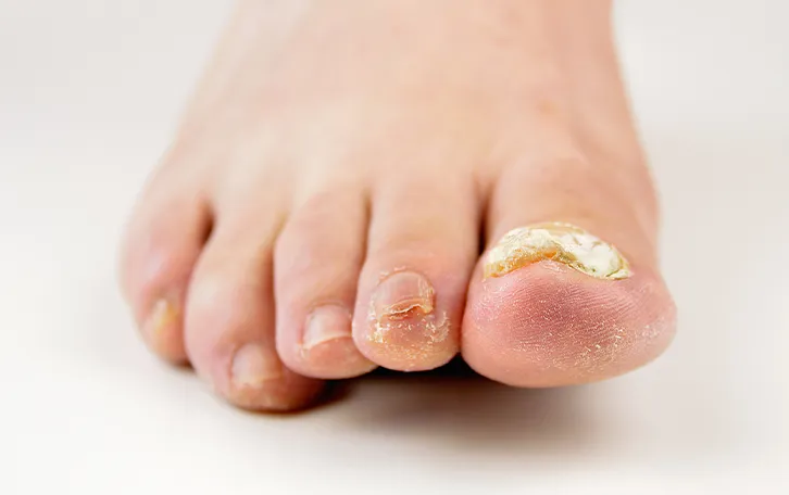 Pilzinfektion Nagelpilz Symptom Nagelverdickung Ein rechter Fuss mit verfärbten und verformten Nagel. Die restlichen Zehen sind schuppig