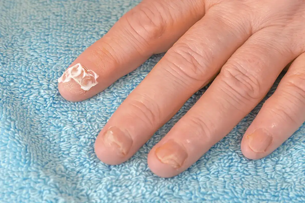 Pilzinfektion Nagelpilz Symptome Sehr kurze Fingernägel an einer linken Hand. Auf dem Nabgelbett des Zeigefinger ist Creme
