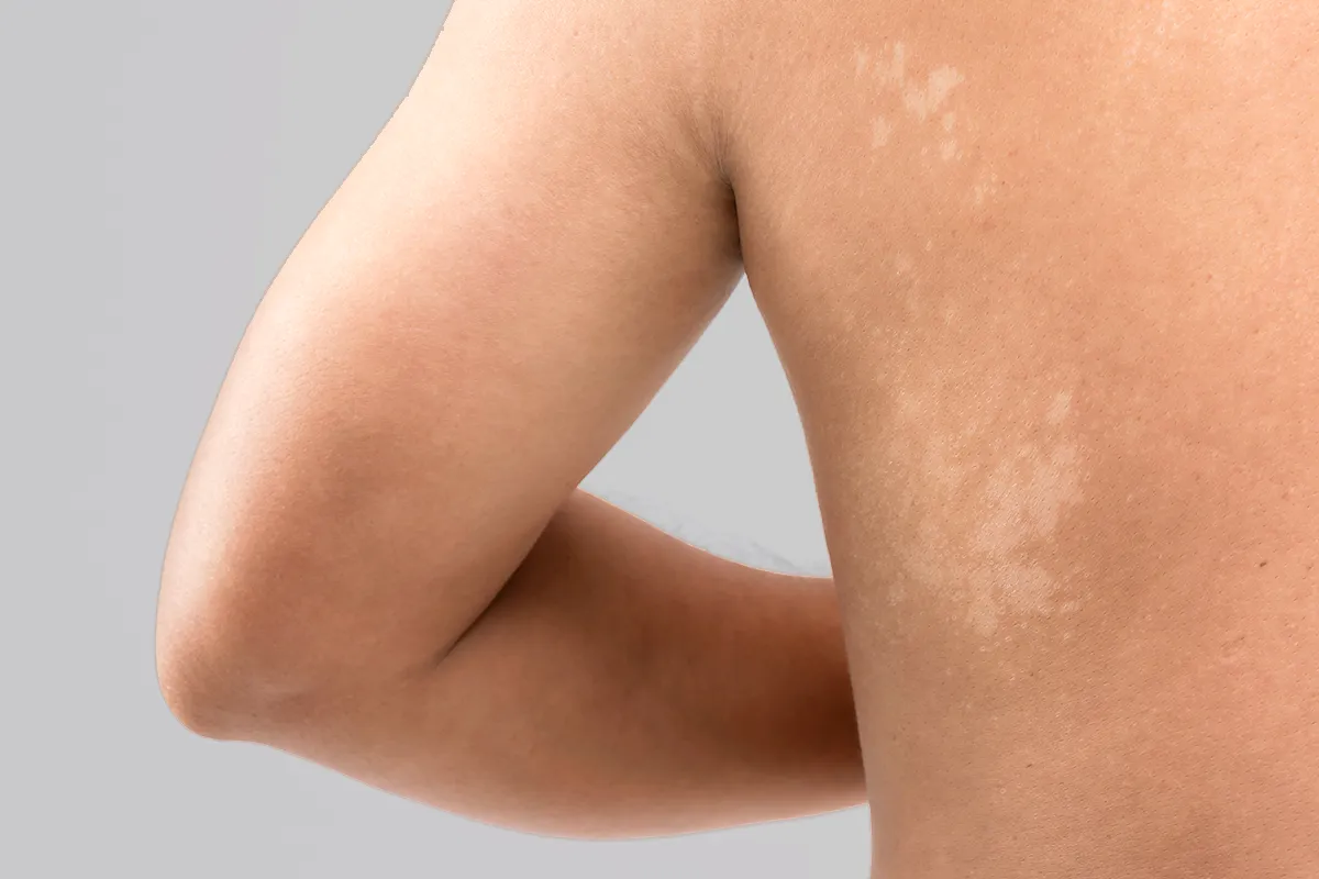 Pikmentstörungen im Schulterblattbereich