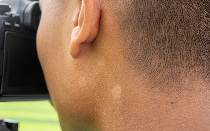Pikmentstörungen am Halsbereich direkt hinter dem linken Ohr