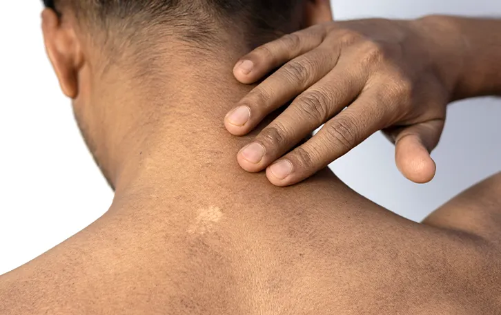 Pikmentstörungen im Nackenbreich nahe der Wirbelsäule