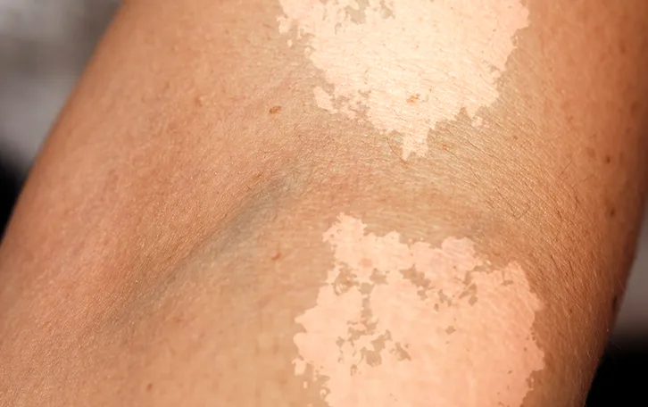 Nahaufnahme von großen Pikmentflecken im Beugebereich eines Arms