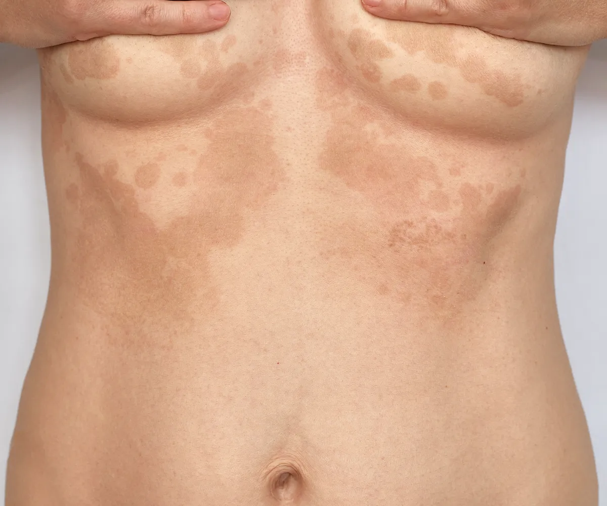 Pikmentstörungen im Brust und oberer Bauchbereich einer weiblichen Person