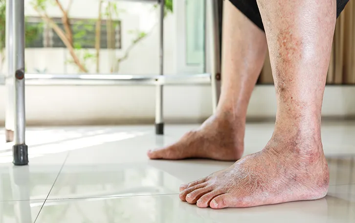 Altersflecken auf den Unterbeinen einer Person