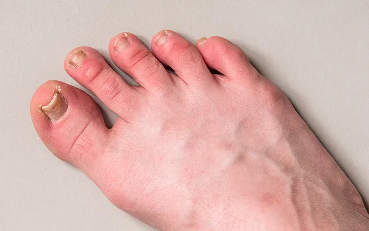 Ein rechter Fuss mit rötlichen Zehen und dunkel gefärbten Zehnägeln