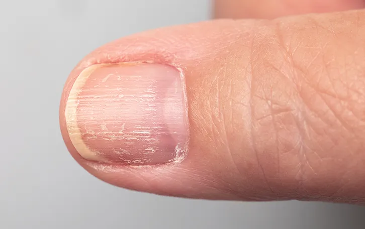 Großaufnahme von einem schuppigen Daumennagel