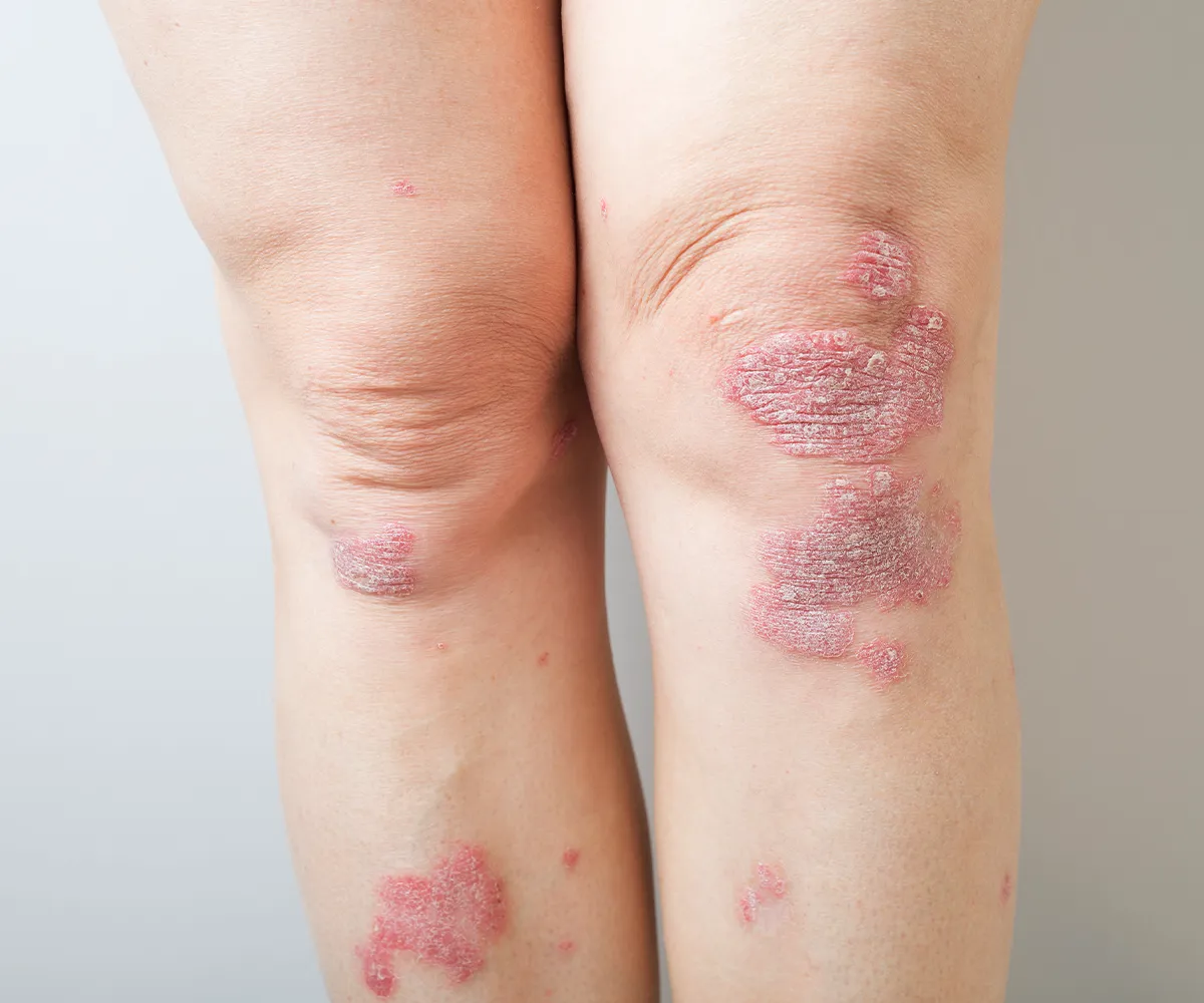 Pilzinfektion Symptome andere Hautkrankheiten Große offene, rissige, rötliche Stellen an zwei Beinen im Knie bis Unterschenkelbereich