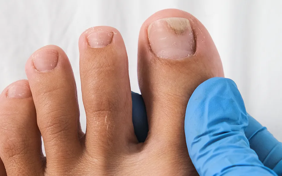 Pilzinfektion Symptome bei Nagelpilz Nahaufnahme eines dicken Zehs, der durch eine Hand in Latex Handschuhen gehalten wird