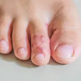 Pilzinfektion Symptome Hautpilz Bläschenbildung Nahaufnahme von Bläschenbildung am Zehrücken am rechten Fuss