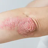 pilzinfektion-symptome-hautpilz-hautverdickung Großflächige rote, rissige Haut am linken äußeren Ellebogen