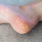 Pilzinfektion Symptome Hautpilz rissige Haut Ein linker Fuss seitlich liegend mit extrem trockener bis rissige Haut. Durch die Risse starke Rötung des Fuss