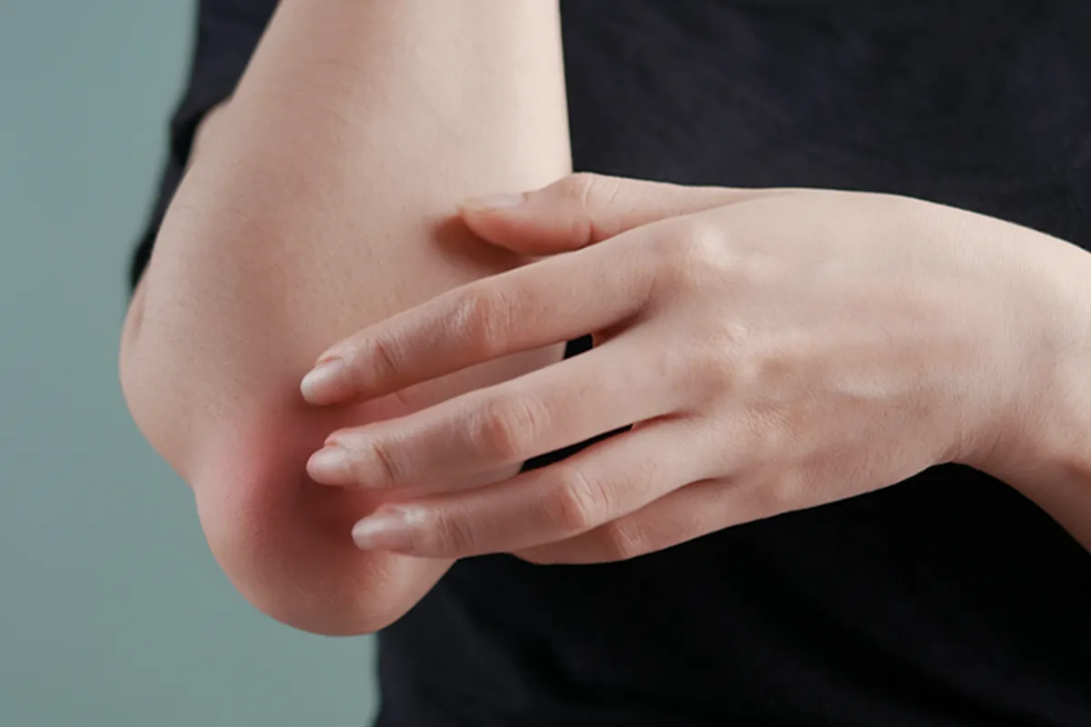 Pilzinfektion Symptome Juckreiz Schuppung Gerötete Haut am Ellebogengelenk