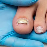 Pilzinfektion Symptome Nagelpilz lockerer Nagel Ein Hand in Latex Handschuh hält einen rechten Fuss mit rissigem dunkel verfärbten dicken Zehnnagel