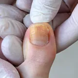 Pilzinfektion Symptome Nagelpilz Schmerzen Hände in Latex Handschuhen halten einen Fuss mit dem Fokus auf den dicken verfärbten Zehnagel