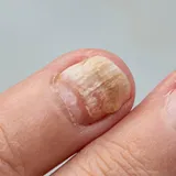 Pilzinfektion Symptome Nagelpilz Verformung Ein Daumennagel, der aussieht als hätte sich der Nagel vom Bett großflächig gelöst