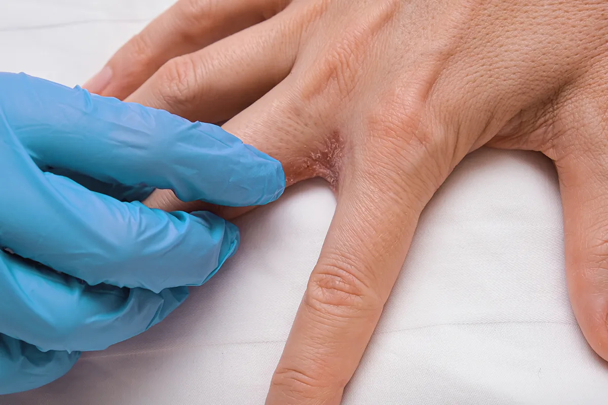 Pilzinfektion was ist Interdigitalmykose Eine Hand in Latexhandschuhen spreitzt die Finger einer Hand. Dazwischen ist eine offene rissige rötliche Stelle