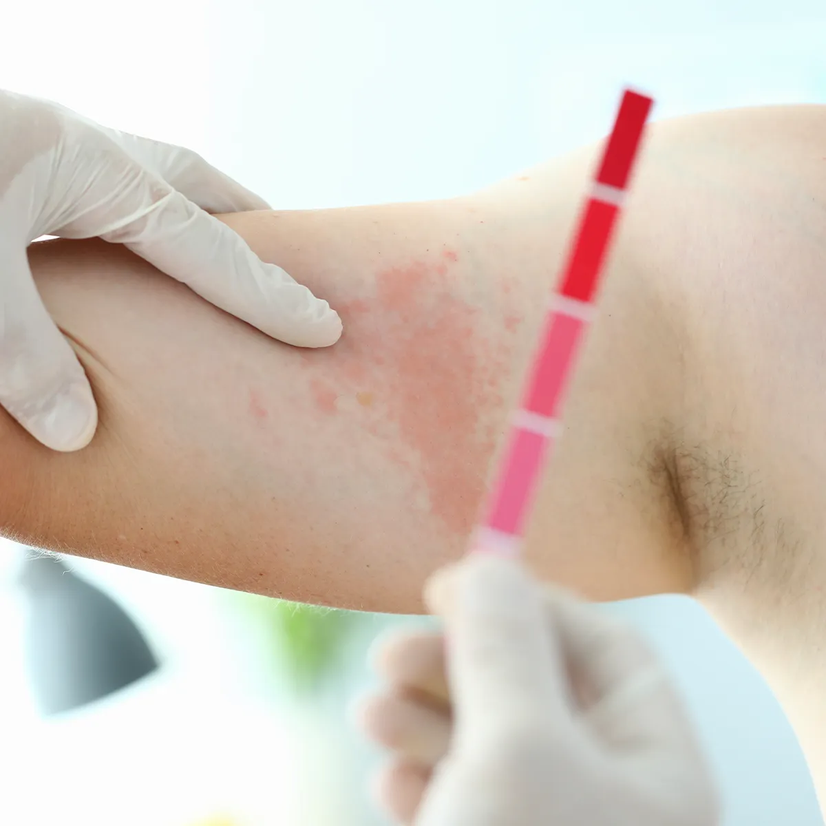 Ein Messstab wird vor einen Ausschlag im inneren Oberarmbereich gehalten