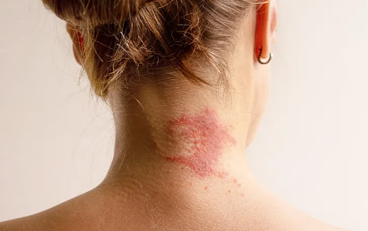 Größes rötliches bis offenes Ekzem im rechten Nackenbereich einer weiblichen Person