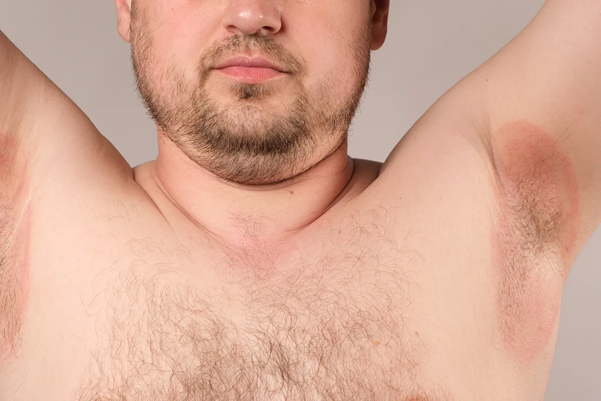 Männlich Person mit gerötetem Achselbereich