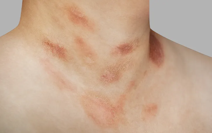 Nahaufnahme von schuppigen Flecken im Halsbereich