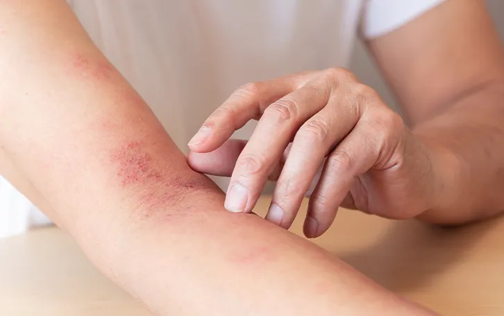 Eine extrem geörtete bis offene Ellebogenbeuge auf der die Hand des anderen Arm anliegt